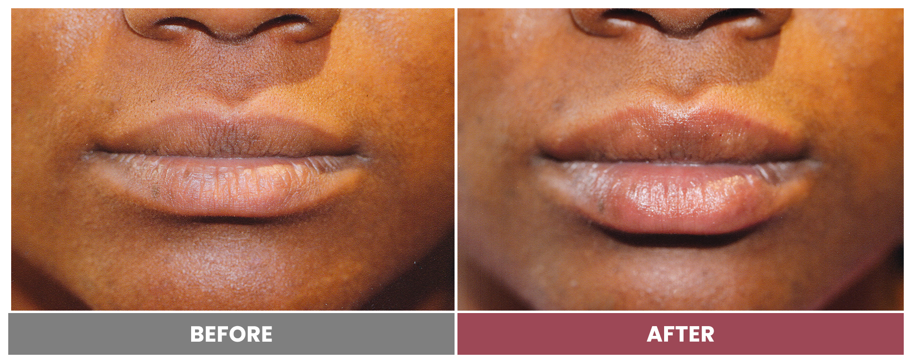 RESTYLANE - Case 4